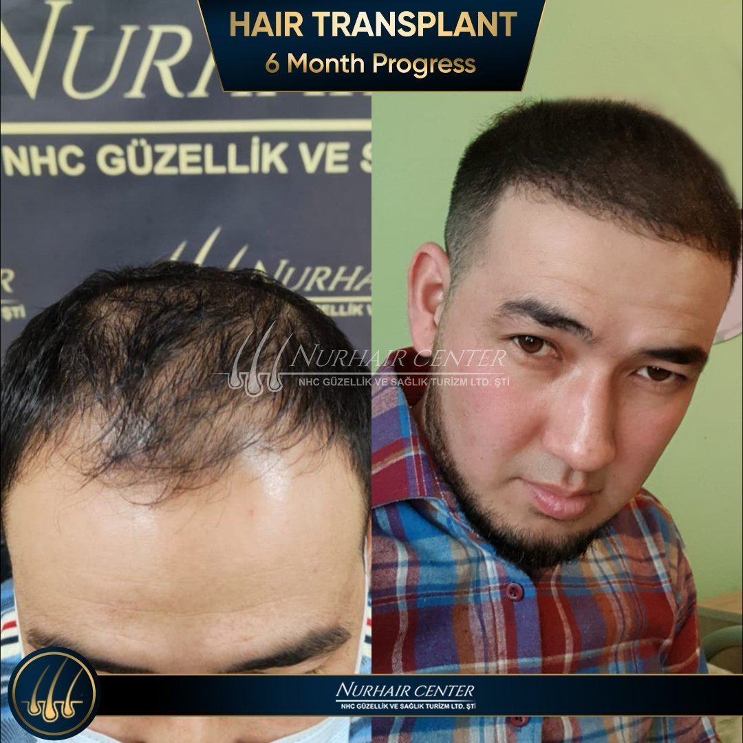 Hair Transplant Turkey - NurHair Center